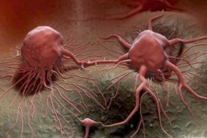 Sedam ranih simptoma raka koje ne smete da ignorišete