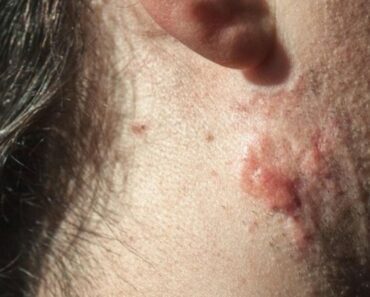 7 ZNAKOVA RAKA KOŽE KOJIH NISTE NI SVESNI: Vreme je da se zaustavite i dobro zapitate, ŽIVOT je u pitanju!