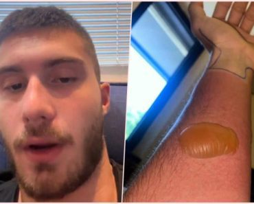 “Ustajem ujutru i imam šta da vidim”: Marko doživeo šok kada je spazio ovo na ruci, ali je tek odlaskom u bolnicu počela agonija “Ustajem ujutru i imam šta da vidim”: Marko doživeo šok kada je spazio ovo na ruci, ali je tek odlaskom u bolnicu počela agonija